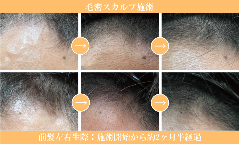 毛密スカルプ施術　結果、効果写真