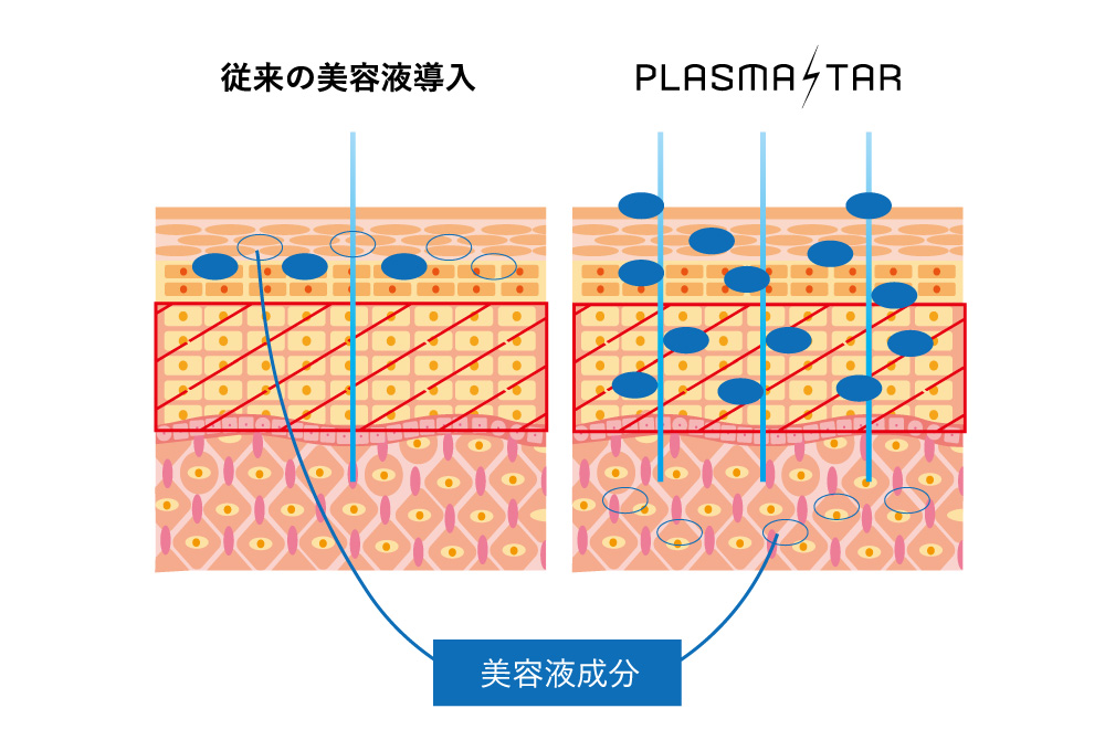 プラズマスター(美容プラズマ)従来の美王機器との導入効果の違い