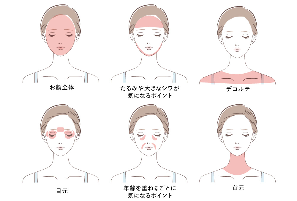 プラズマスターで施術できる範囲