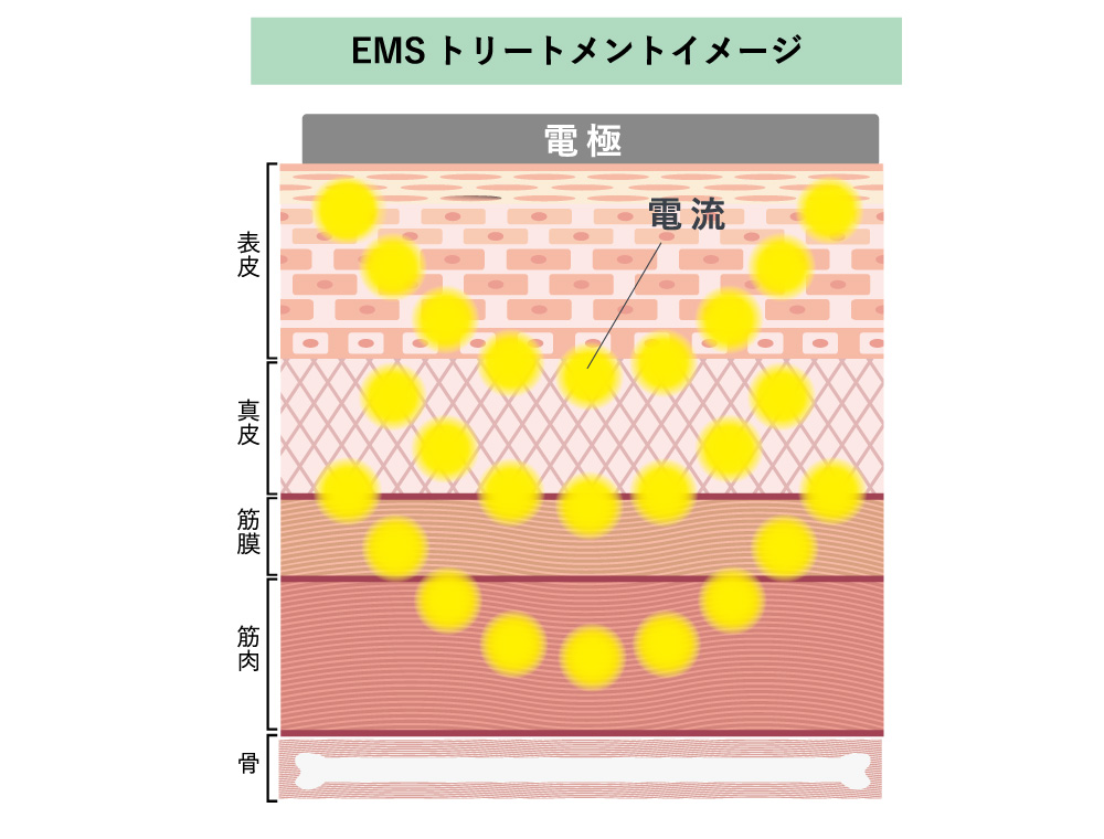 プラズマスターはEMSもすごい効果