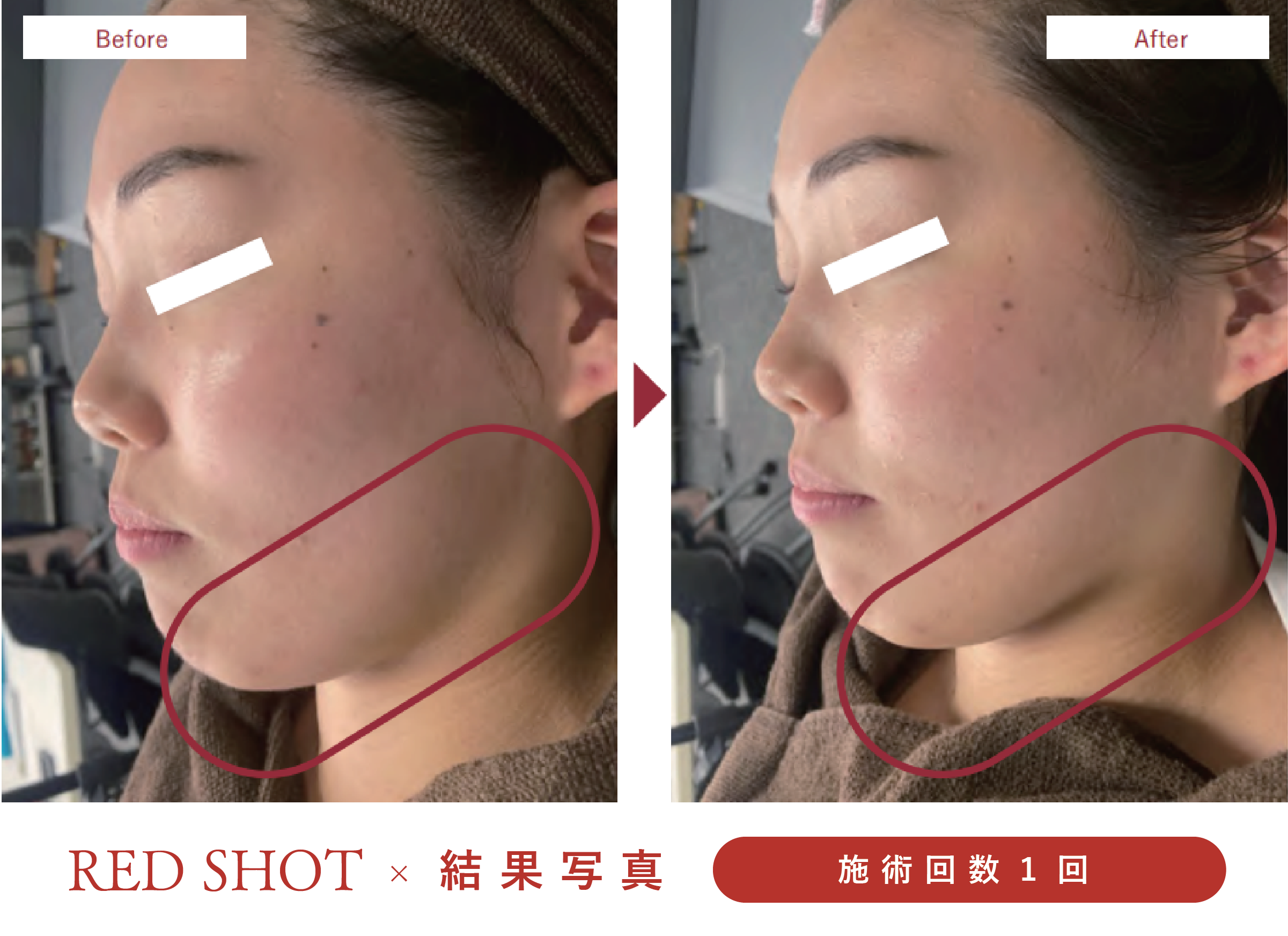 美ヨウ部、レッドショット結果写真、効果写真、フェイスライン施術1回1人目