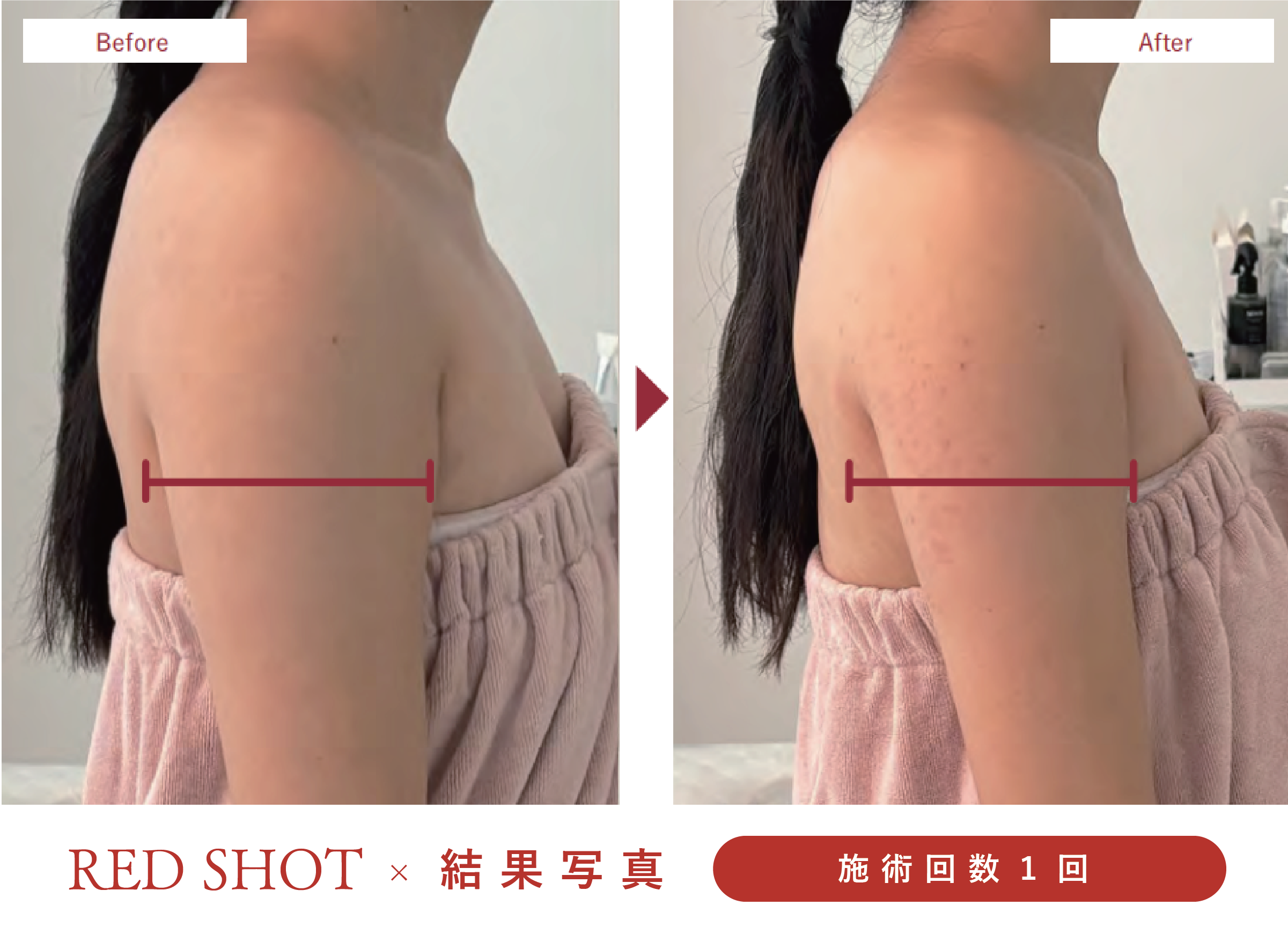 美ヨウ部、レッドショット結果写真、効果写真、二の腕施術1回1人目