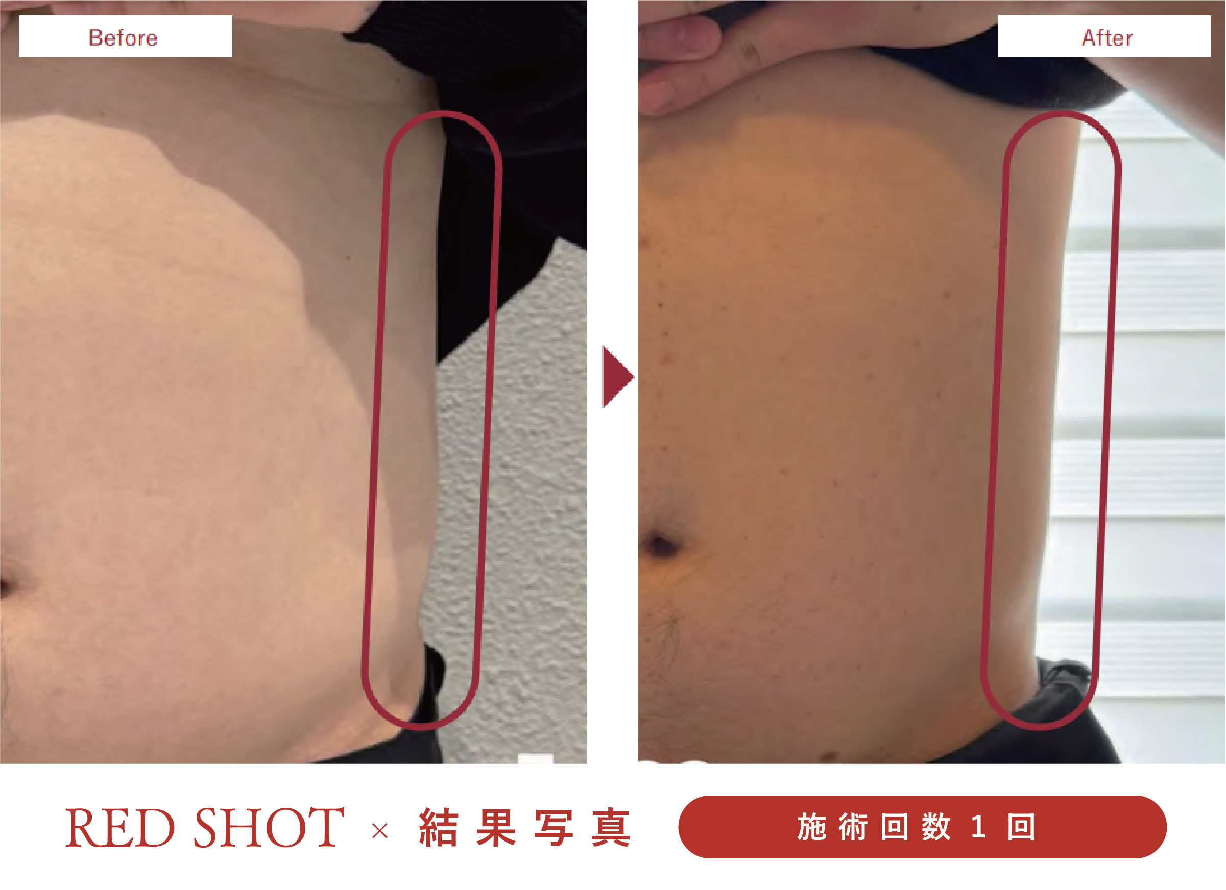 美ヨウ部、レッドショット結果写真、効果写真、脇腹、ウエスト施術1回1人目