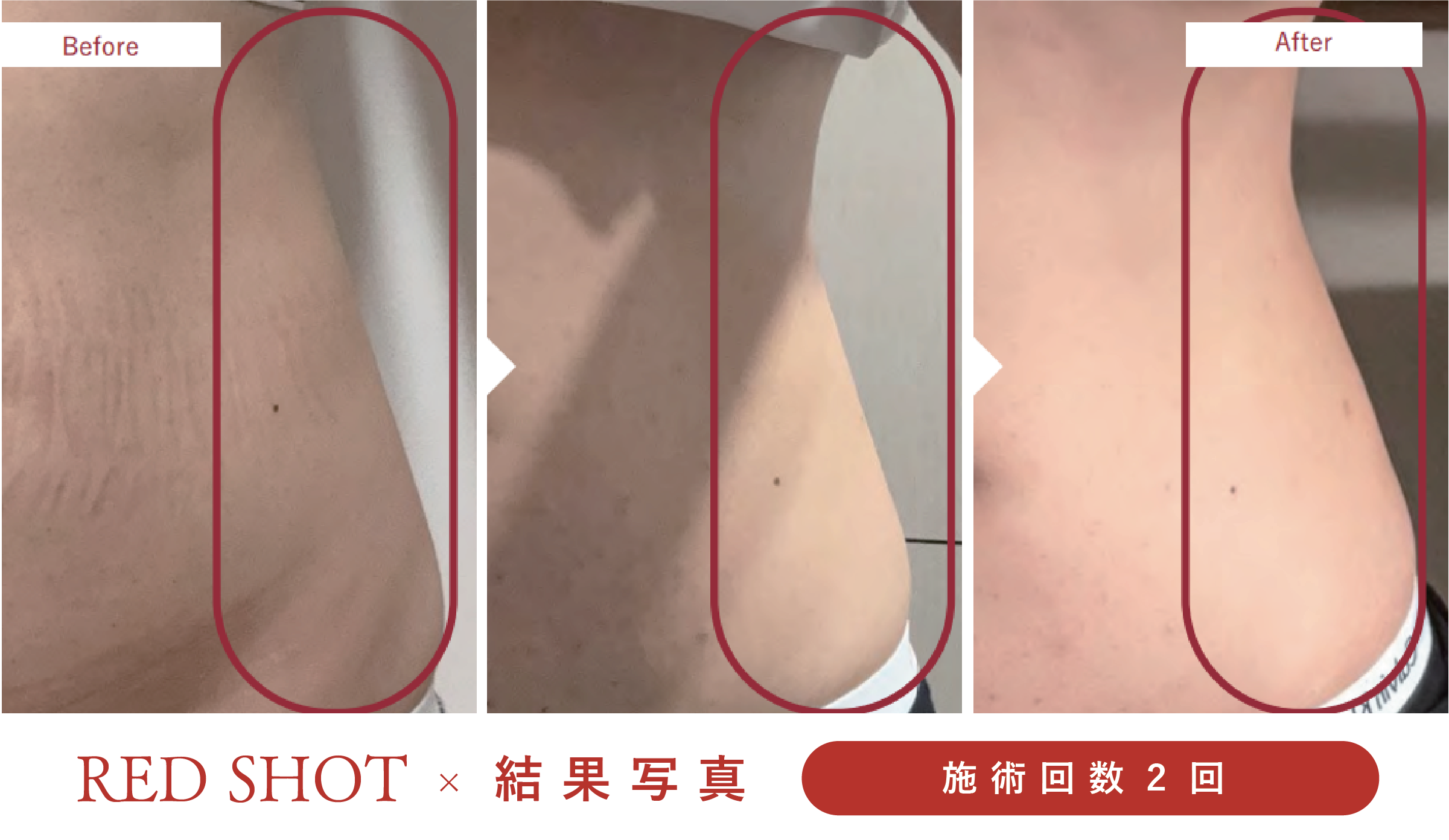 美ヨウ部、レッドショット結果写真、効果写真、脇腹、ウエスト施術1回2人目