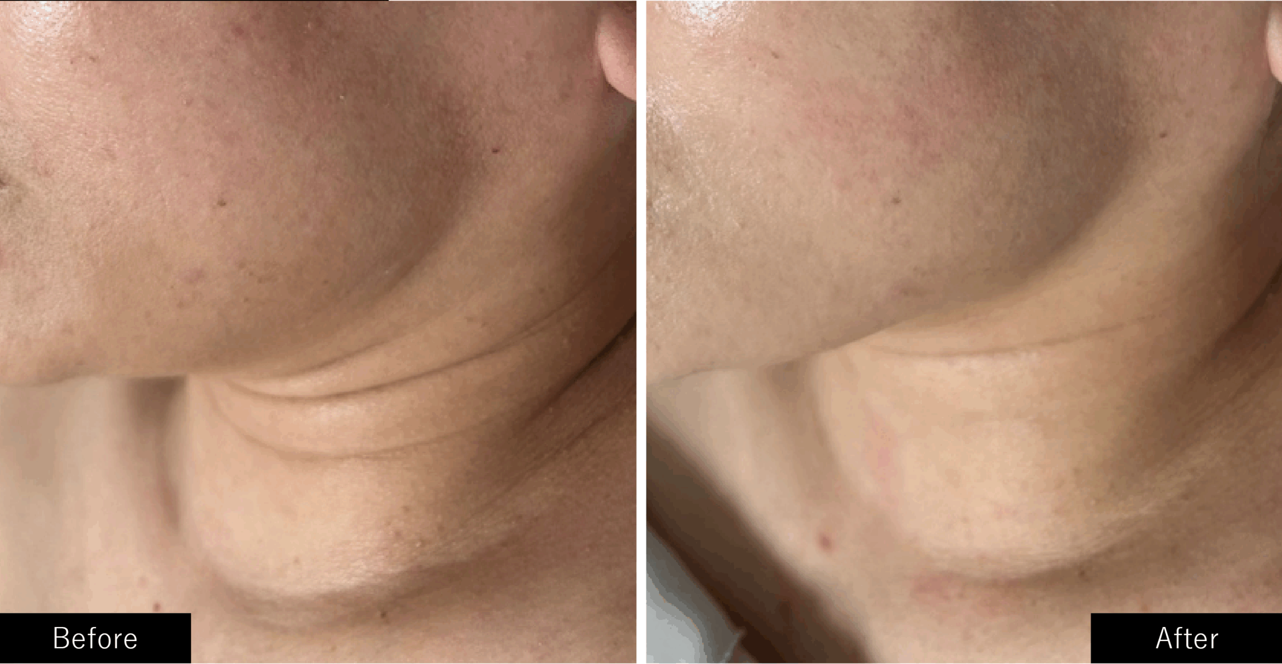 プラズマスター、結果写真、EMS×テラヘルツカッサ【小顔矯正術】