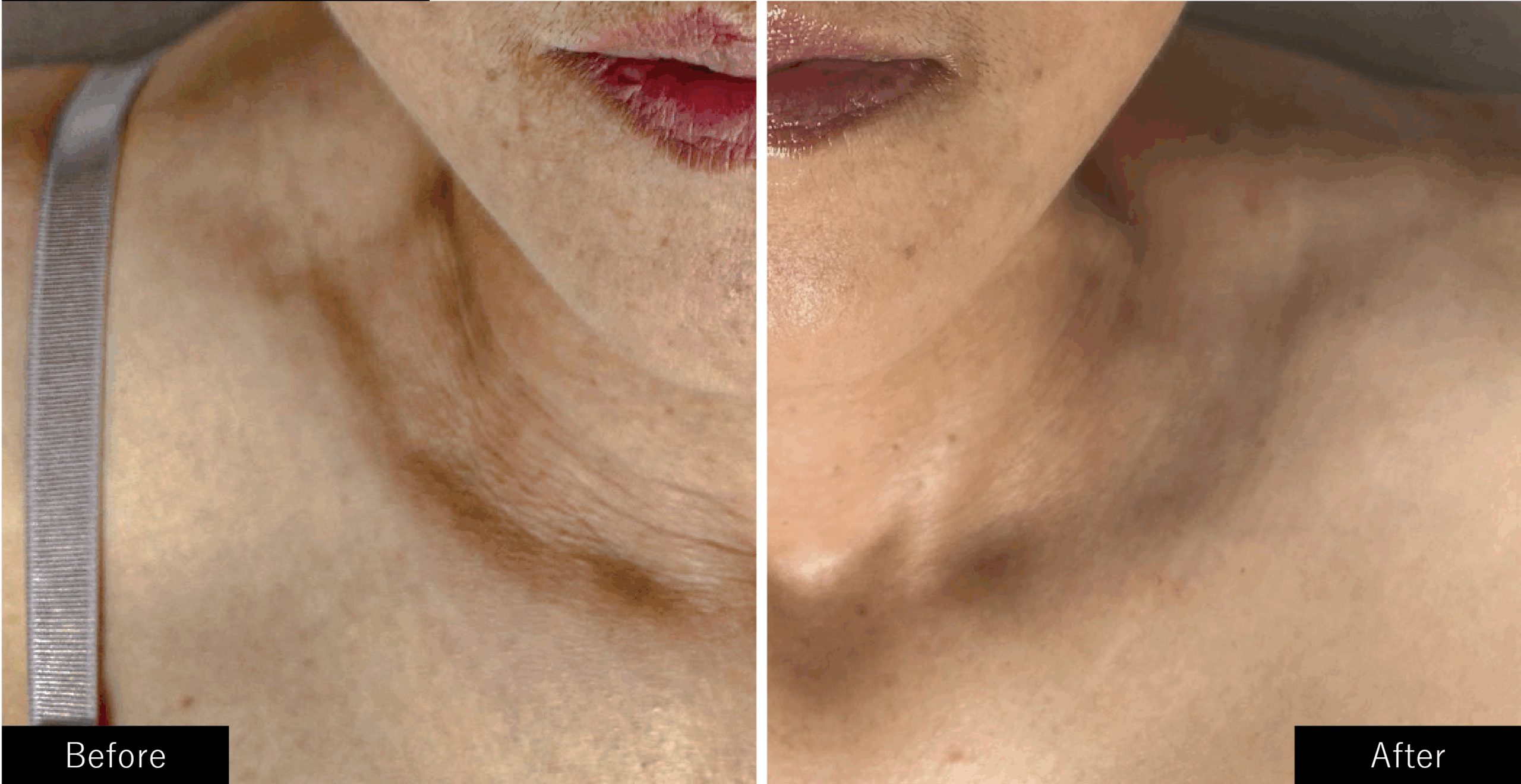 プラズマスター、結果写真、デコルテのシワ改善