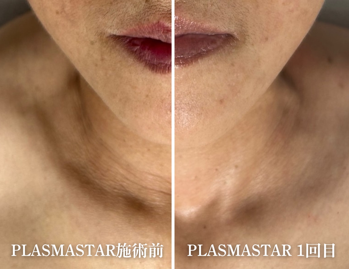 美ヨウ部How toカウンセリング、プラズマスターという「現状打破の選択肢」プラズマスターの首のシワ改善結果写真、1回ビフォーアフター写真