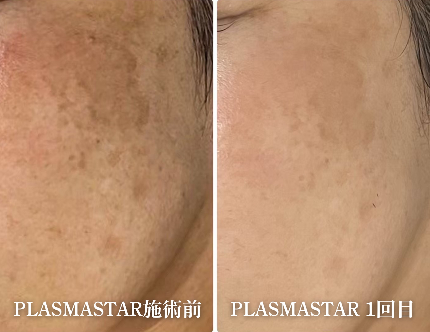美ヨウ部How toカウンセリング、プラズマスターという「現状打破の選択肢」プラズマスターの首の肌質改善結果写真、1回ビフォーアフター写真