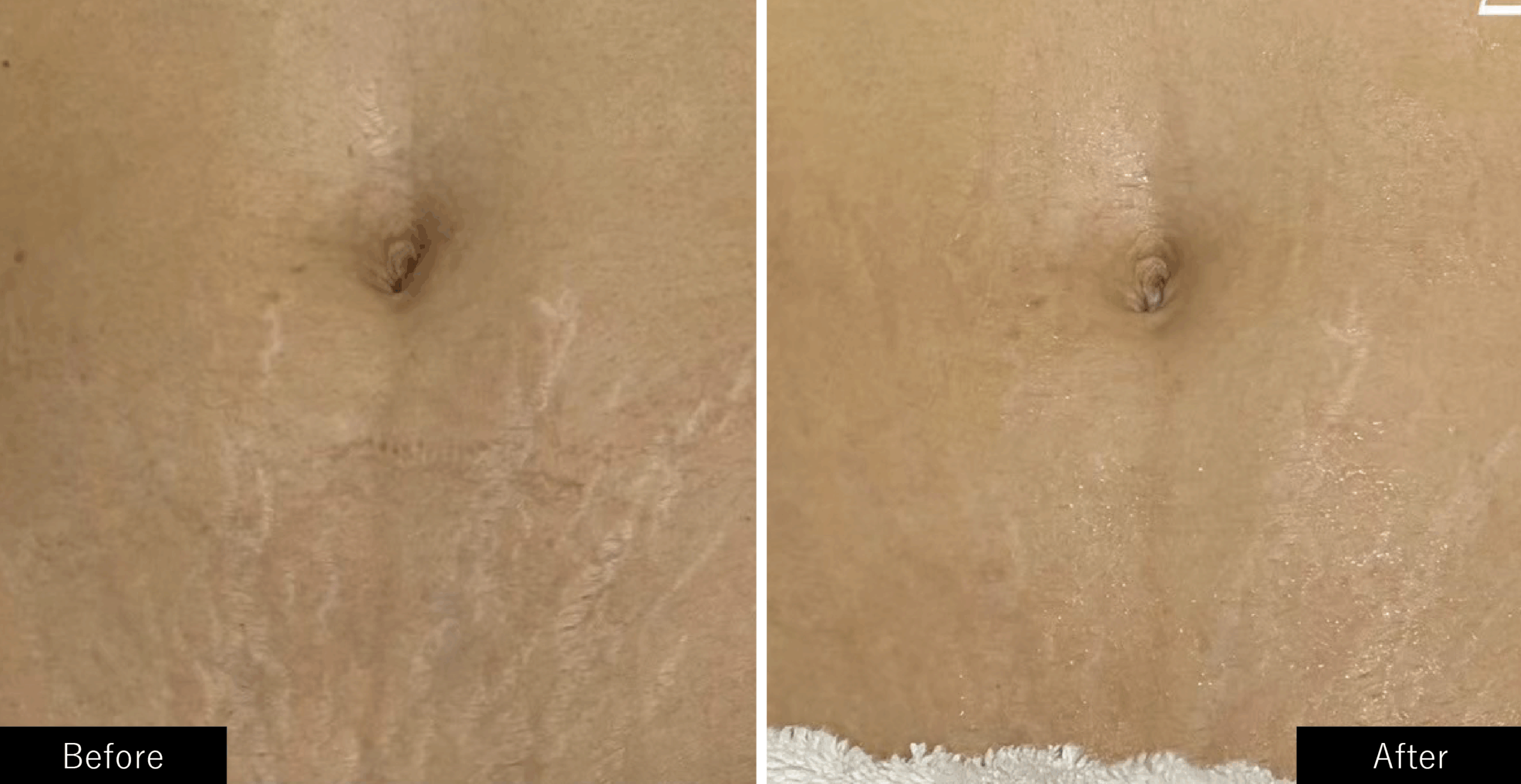 プラズマスターのプラズマ施術で肉割れ線や妊娠線ケアもできます。