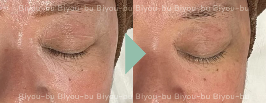 美ヨウ部、プラズマスター(エステプラズマ)の結果写真、目元シワ改善1回目