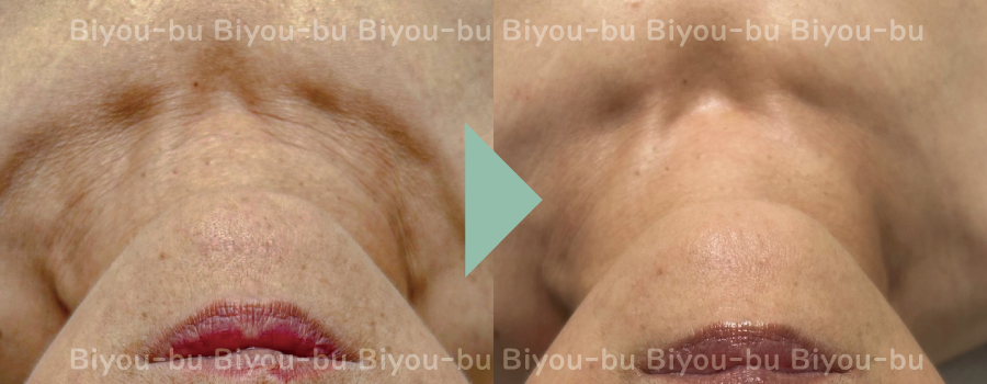 美ヨウ部、プラズマスター(エステプラズマ)の結果写真、首元シワ改善1回目