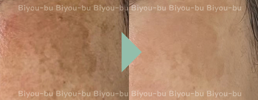 美ヨウ部、プラズマスター(エステプラズマ)の結果写真、肌質改善、シミ1回目