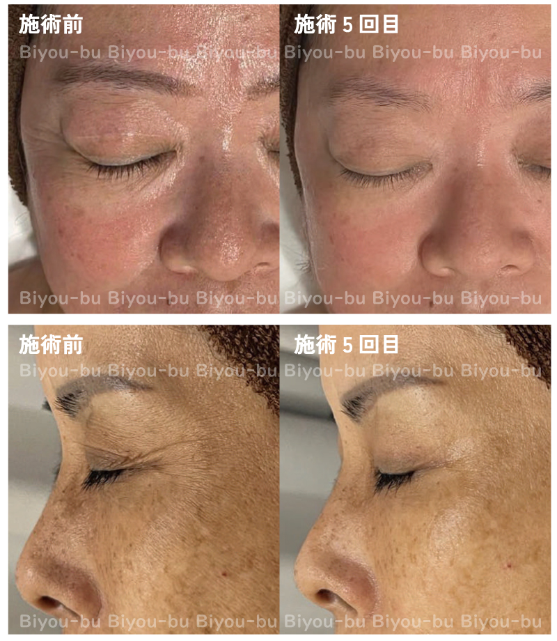 美ヨウ部、プラズマスター(エステプラズマ)の結果写真、肌質改善、目元のシワ改善5回目ビフォーアフター写真